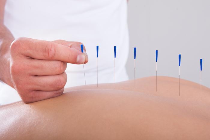 Needles for Health: A Guide to Dry Needling and Acupuncture