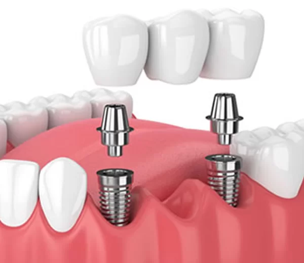 Estetică și Eficiență: Pretul Unui Implant Dentar